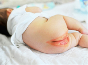 chữa hăm tã cho trẻ sơ sinh 