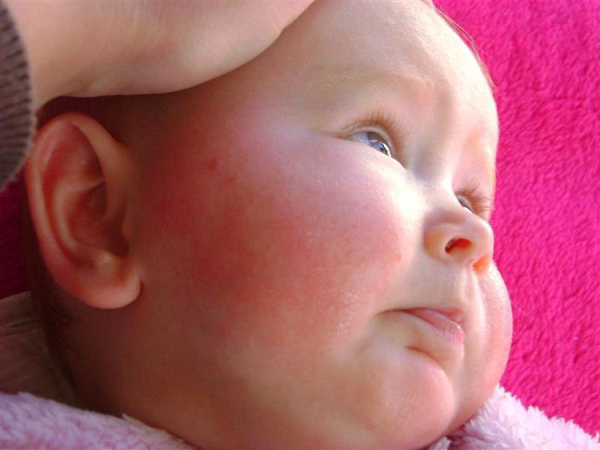 Trẻ sơ sinh bị chàm sữa – Dấu hiệu và nguyên nhân gây bệnh