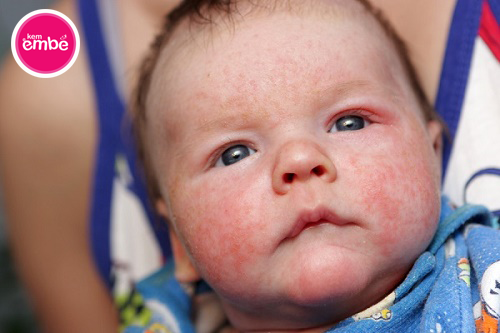 Có khoảng 20% trẻ sinh ra mắc bệnh chàm sữa