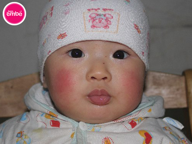 bé bị nẻ má