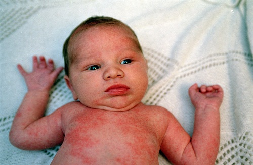 bệnh Eczema ở bé