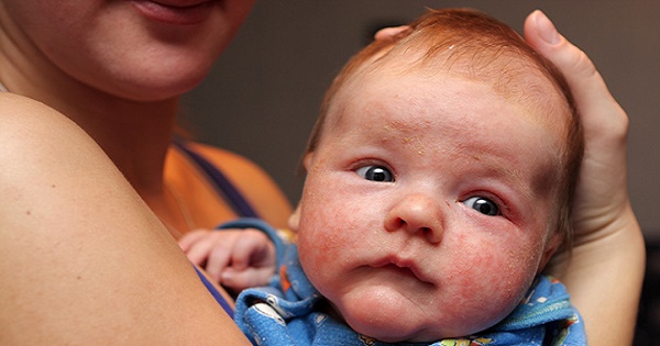 bệnh Eczema ở trẻ