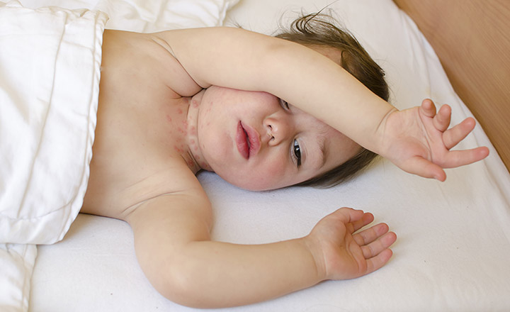 Cách trị hăm cổ ở trẻ sơ sinh