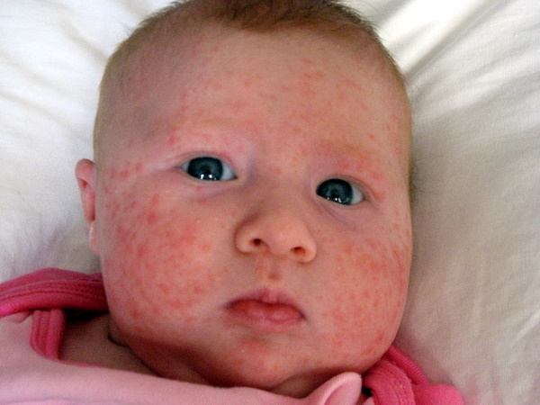 bệnh eczema