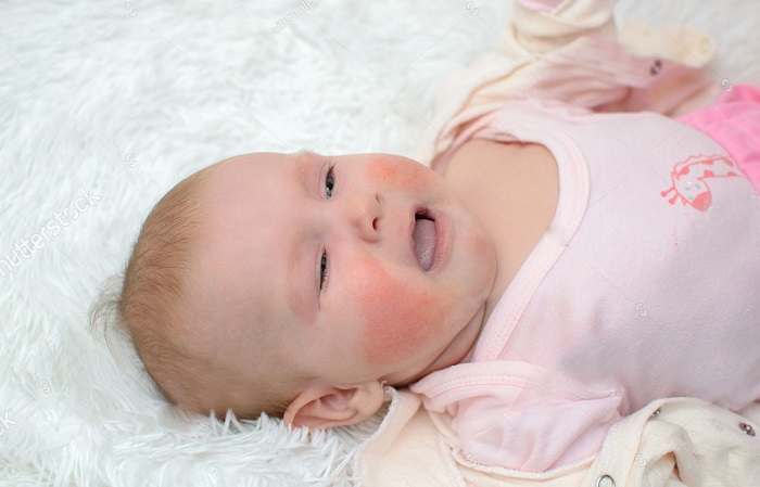 viêm da cơ địa ở trẻ sơ sinh