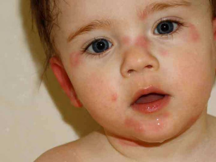 bệnh eczema ở bé