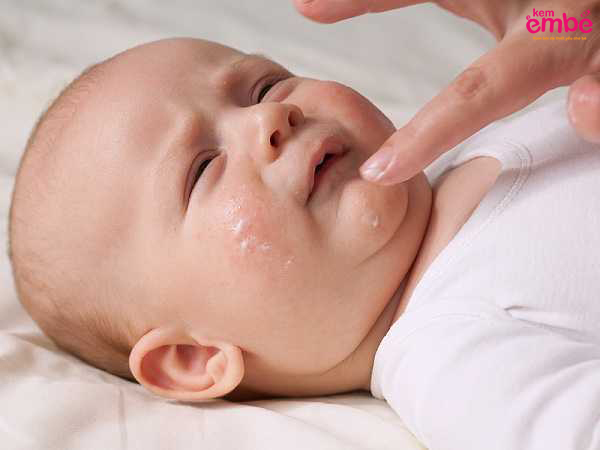 Bố mẹ tránh dùng tay trực tiếp bôi thuốc lên mặt trẻ