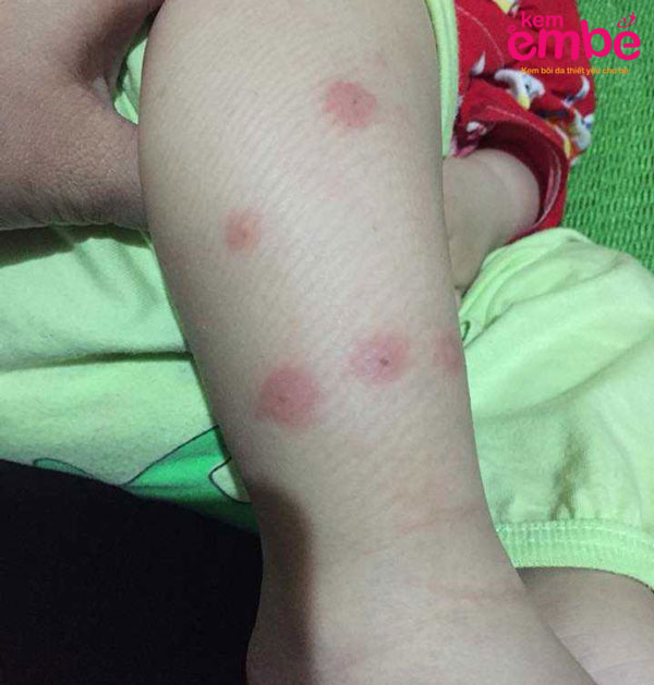 Hình ảnh bé bị muỗi đốt ở chân nổi mẩn đỏ