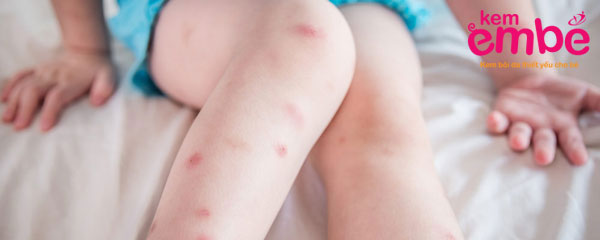 Phương pháp tự nhiên chữa cho trẻ bị muỗi đốt sưng cứng