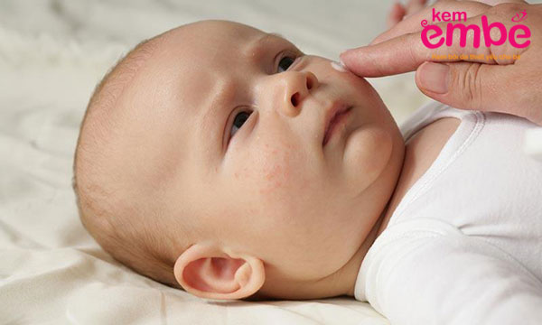 Vết muỗi cắn thường ở trên mặt của bé