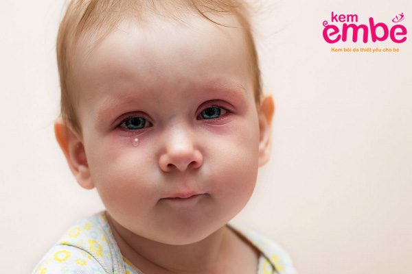 Biến chứng nguy hiểm của việc bé bị côn trùng đốt sưng mắt 