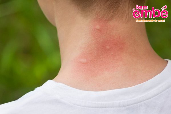 Sưng đỏ vùng da là triệu chứng khi bị côn trùng đốt đau nhức