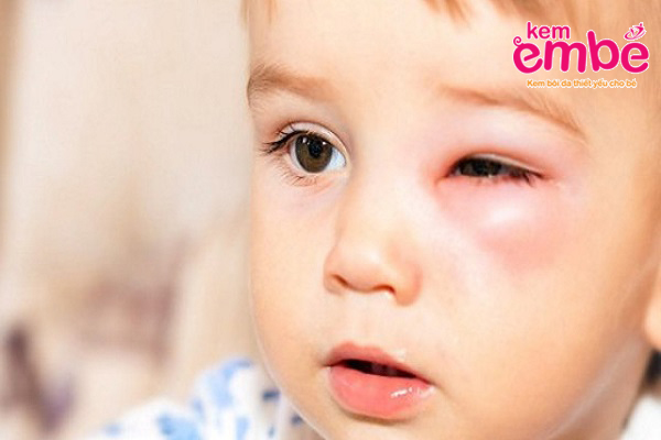 Cách làm sạch vùng sưng mắt sau khi trẻ bị côn trùng đốt?

