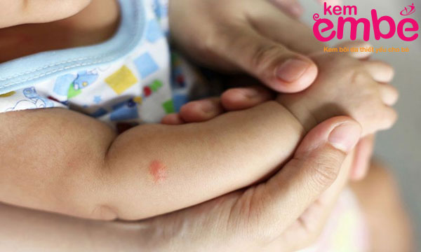 Các triệu chứng khi bé bị muỗi đốt