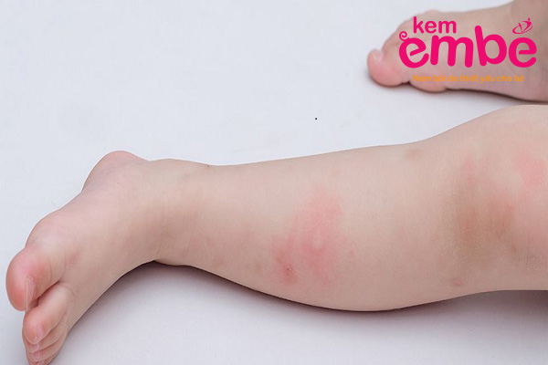Muỗi thường đốt ở bắp đùi và bắp tay 
