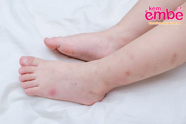 Trẻ bị côn trùng cắn ở chân 