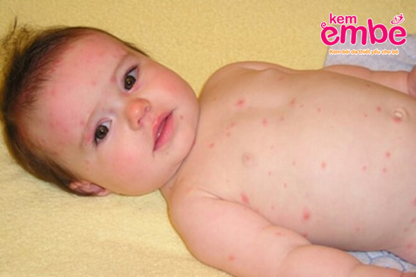 Triệu chứng trẻ bị muỗi đốt nổi mụn nước 