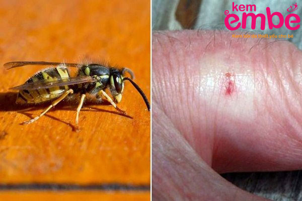 Vết côn trùng cắn do ong bắp cày