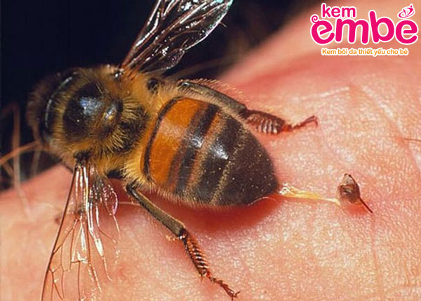 Vết cắn của ong mật