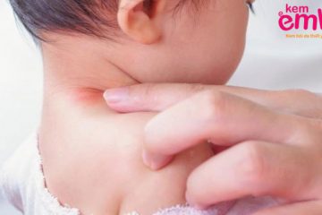 Dưỡng ẩm cho da trẻ đúng cách giúp giảm các triệu chứng của chàm sữa