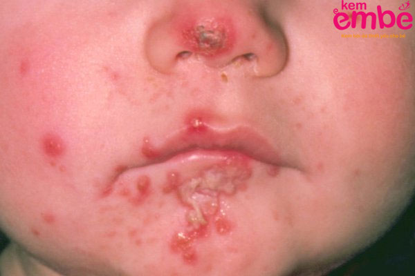 Trẻ bị viêm da dẫn đến bội nhiễm