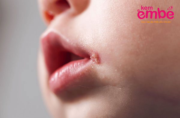 Viêm da dạng herpes ở miệng trẻ