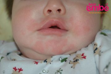 Dấu hiệu viêm da ở trẻ sơ sinh