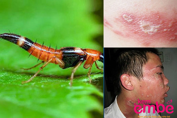 Viêm da tiếp xúc kích ứng ở trẻ do côn trùng cắn