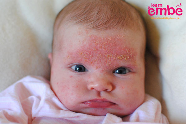 Bệnh viêm da tiết bã trên mặt ở trẻ sơ sinh