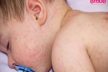 Các bệnh viêm da ở trẻ nhỏ